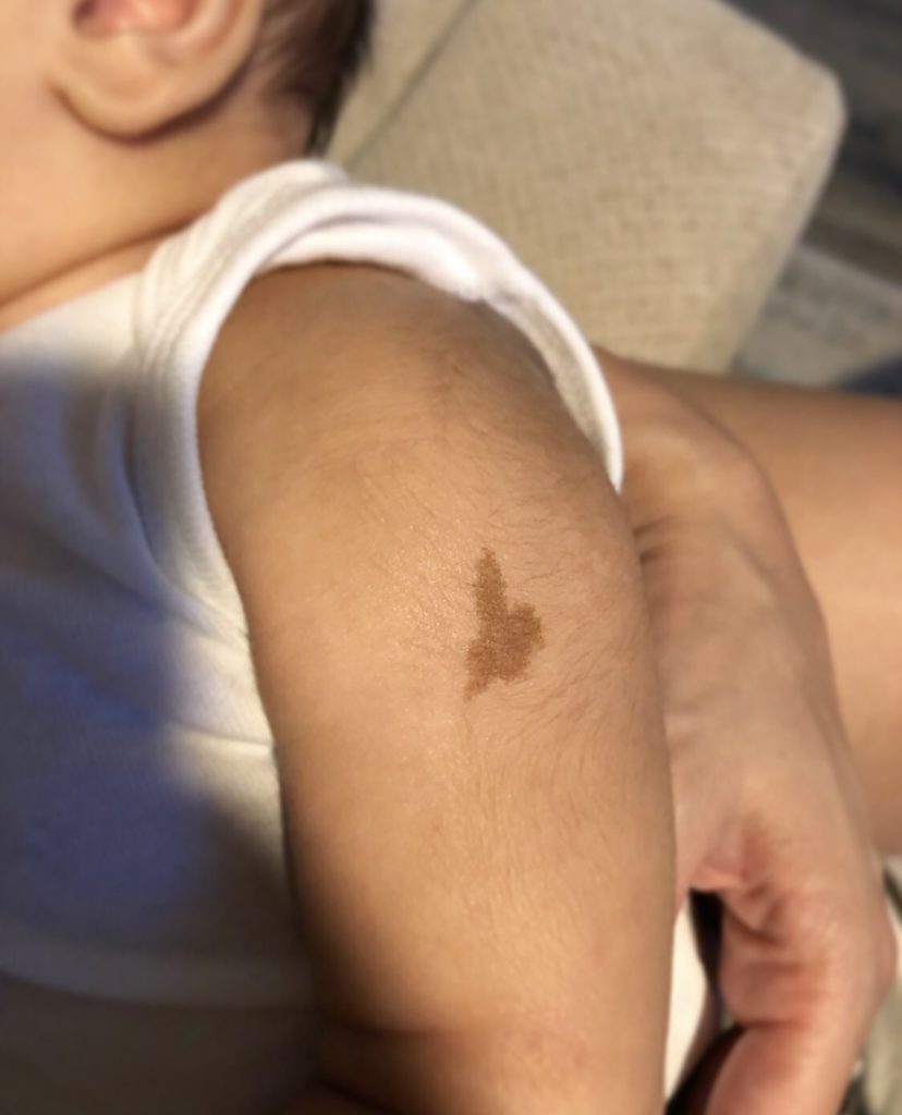 Arm birthmark