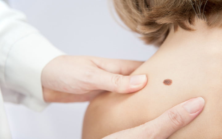 What do birthmarks mean: back birthmark