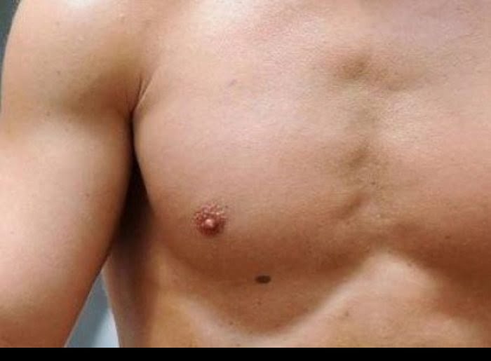 Chest birthmark