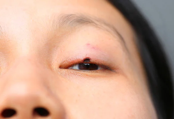 What do birthmarks mean: eyes birthmark
