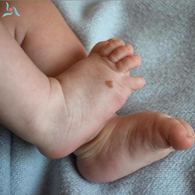 What do birthmarks mean: foot birthmark