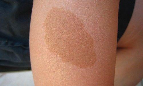 What do birthmarks mean: Pigmented birthmark